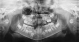 Dental Radiographs (X-Rays) - Pediatric Dentist in Ridgecrest, CA